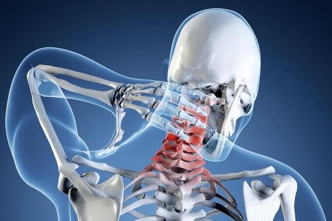 Osteochondrose ersten Grades