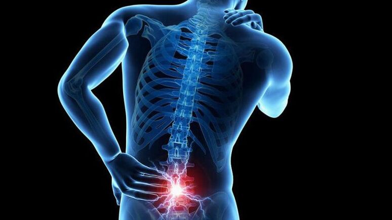 Lumbale osteochondrosikalische Symptome